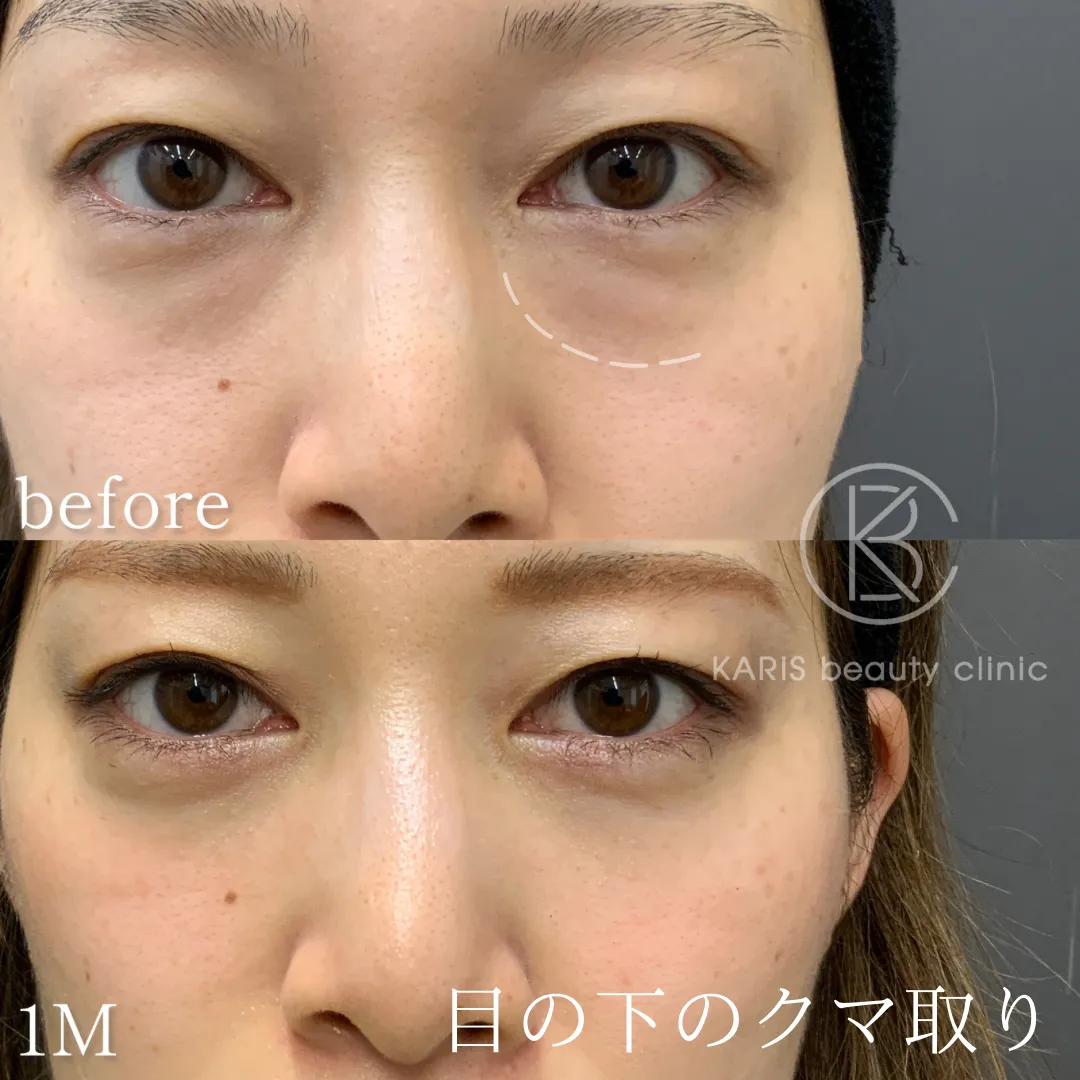 クマ取り（脱脂術）