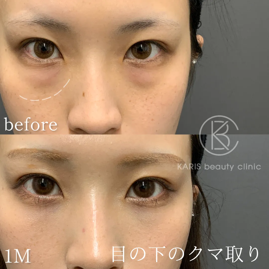 クマ取り（脱脂術）