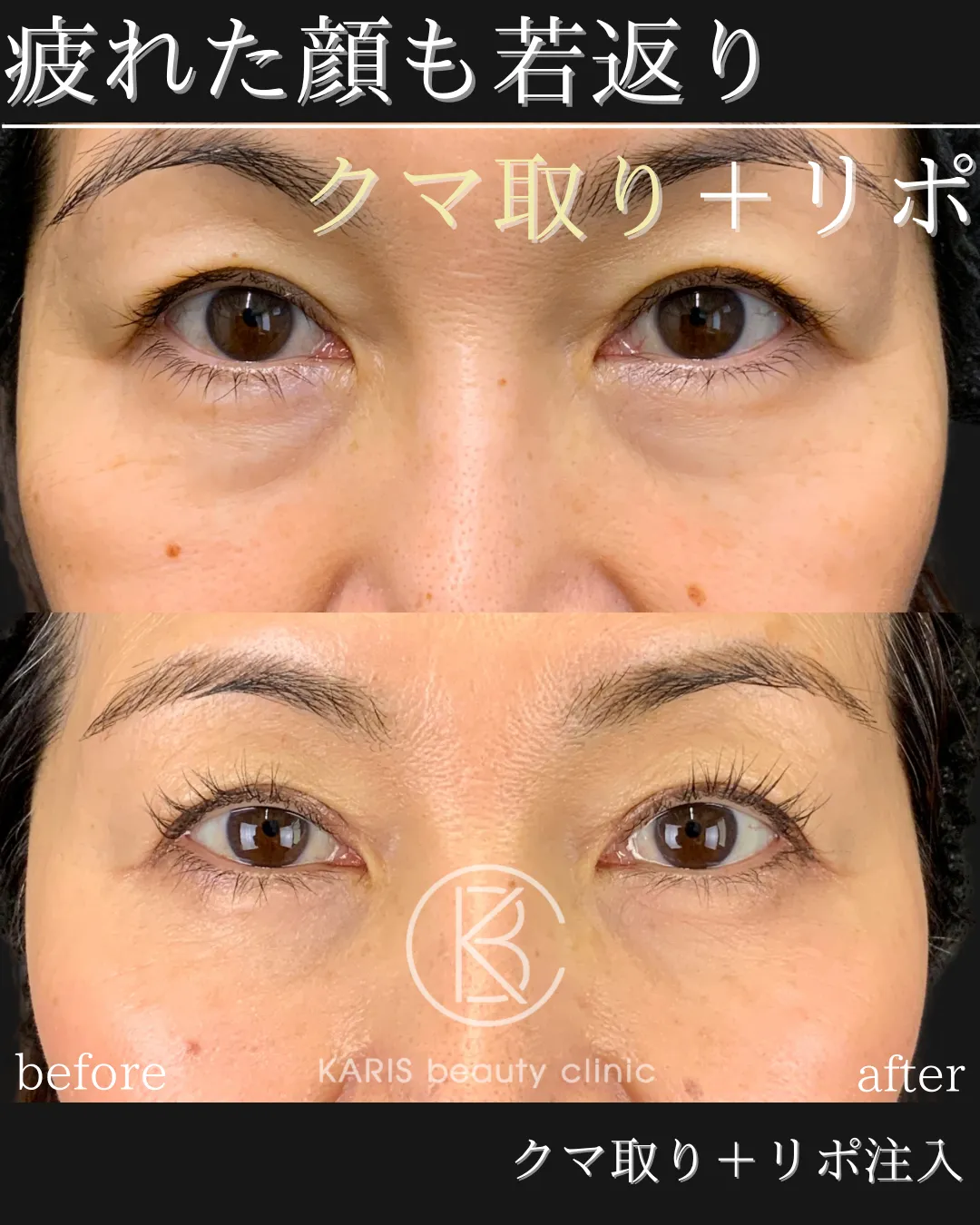 クマ取り +リポ注入