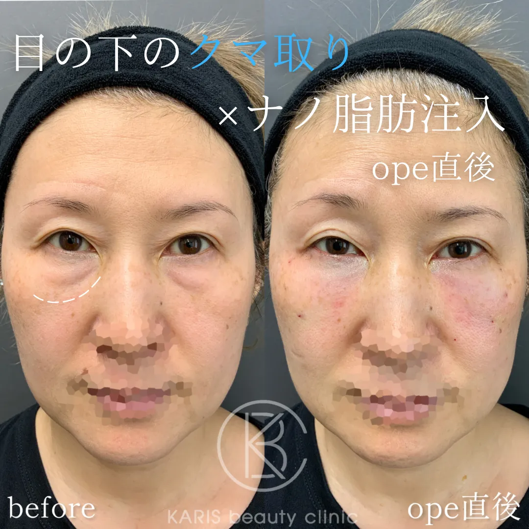 クマ取り +ナノ脂肪注入