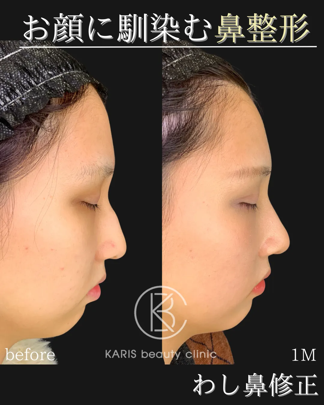 わし鼻修正