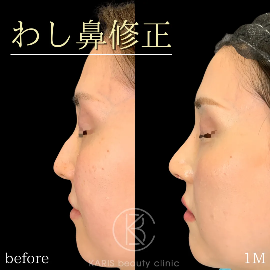 わし鼻修正