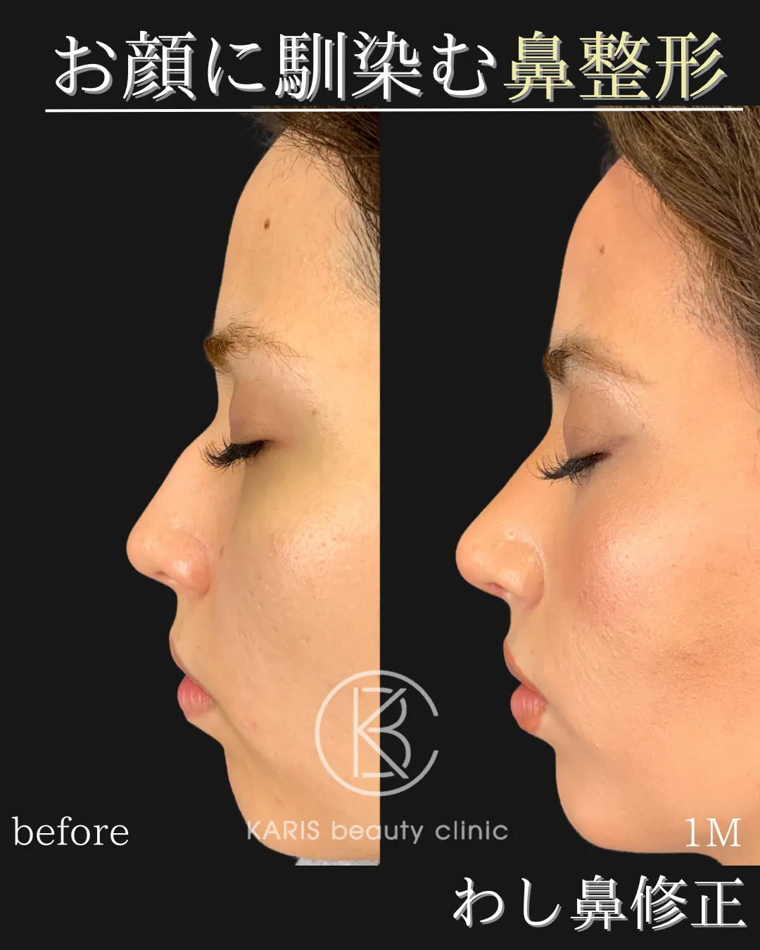 わし鼻修正