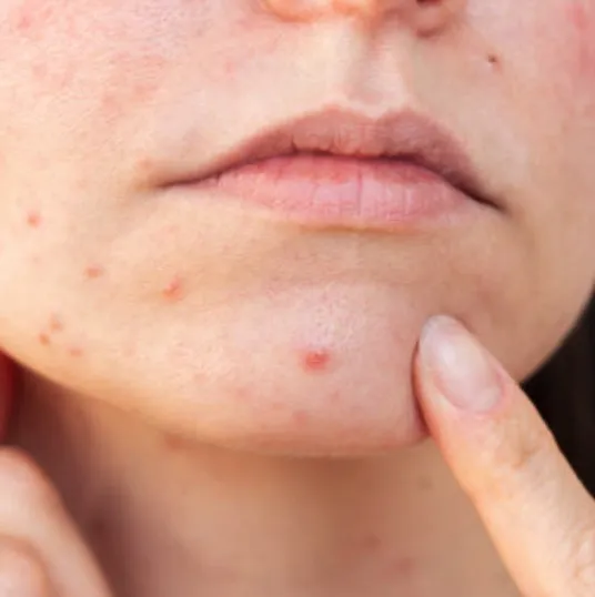 ニキビ・ニキビ跡を治したい